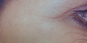 Photo of woman's crows feet after treatment