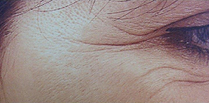 Photo of woman's crows feet before treatment