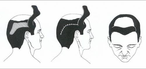 The Evolution of Hair Restoration Surgery - Aesthetics of Essex