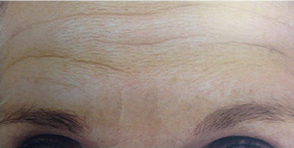 Photo of patient's forehead before treatment