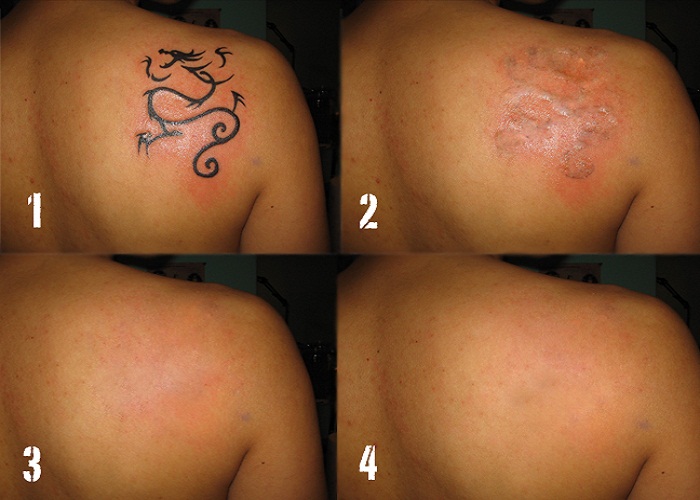 Remove Your Tattoo Disaster! - Aesthetics of Essex