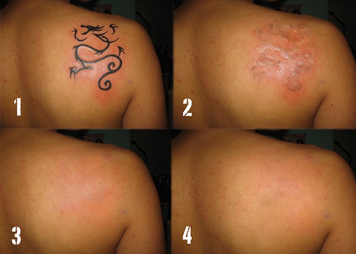 My Experience with Laser Tattoo Removal in NYC before  after