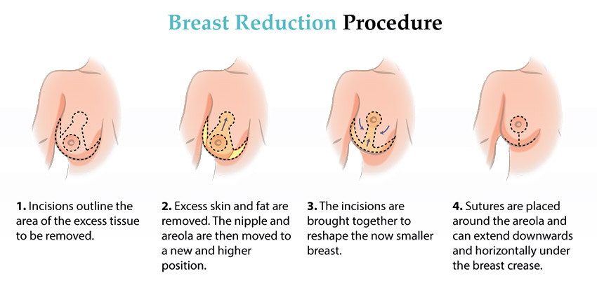 You Might Need Need a Breast Reduction Now!