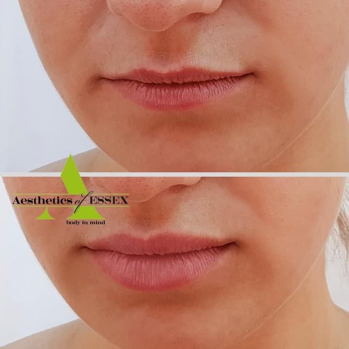 Facial filler for cheeks - Aesthetics of Essex