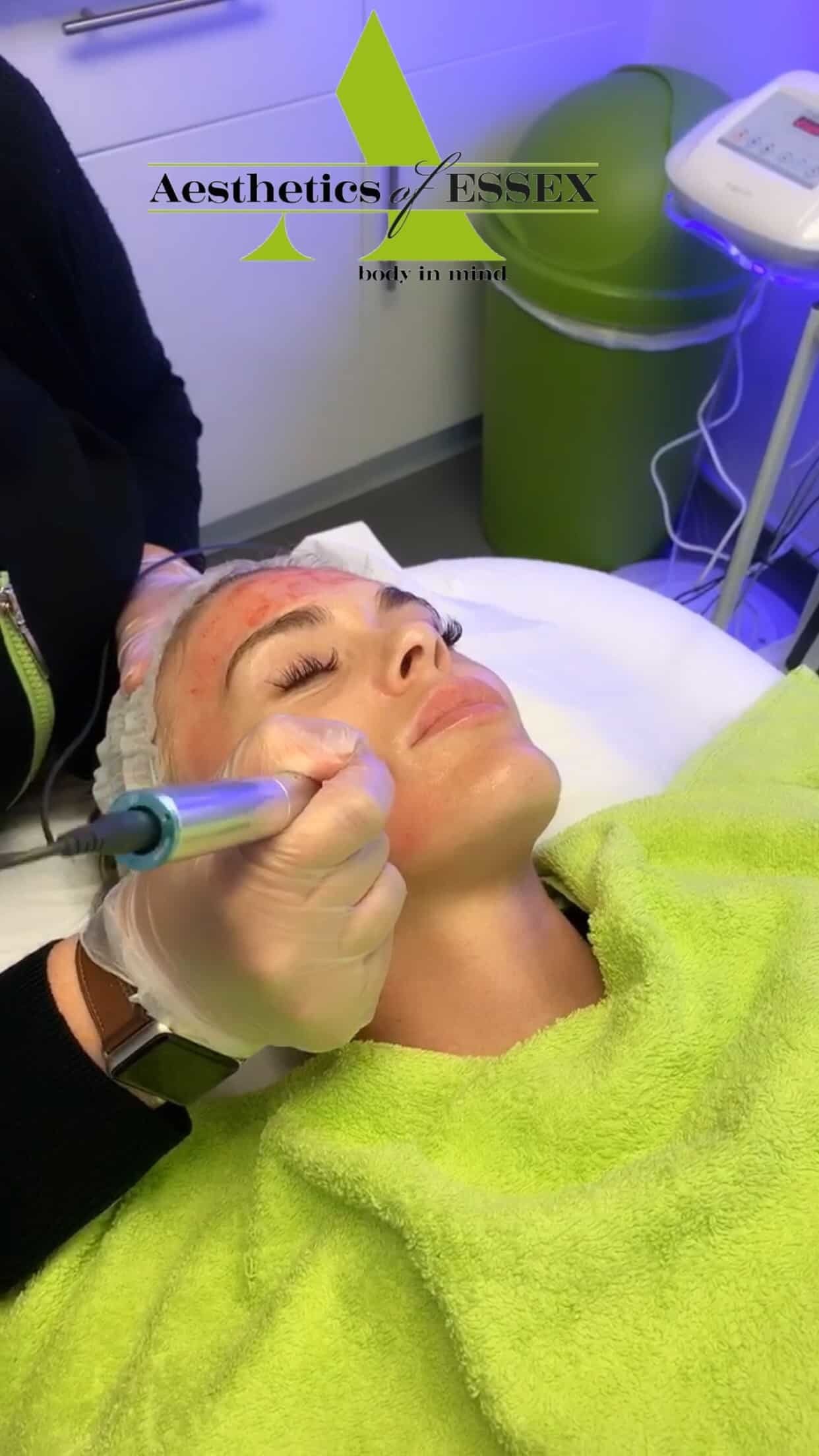 Dermapen - Aesthetics of Essex