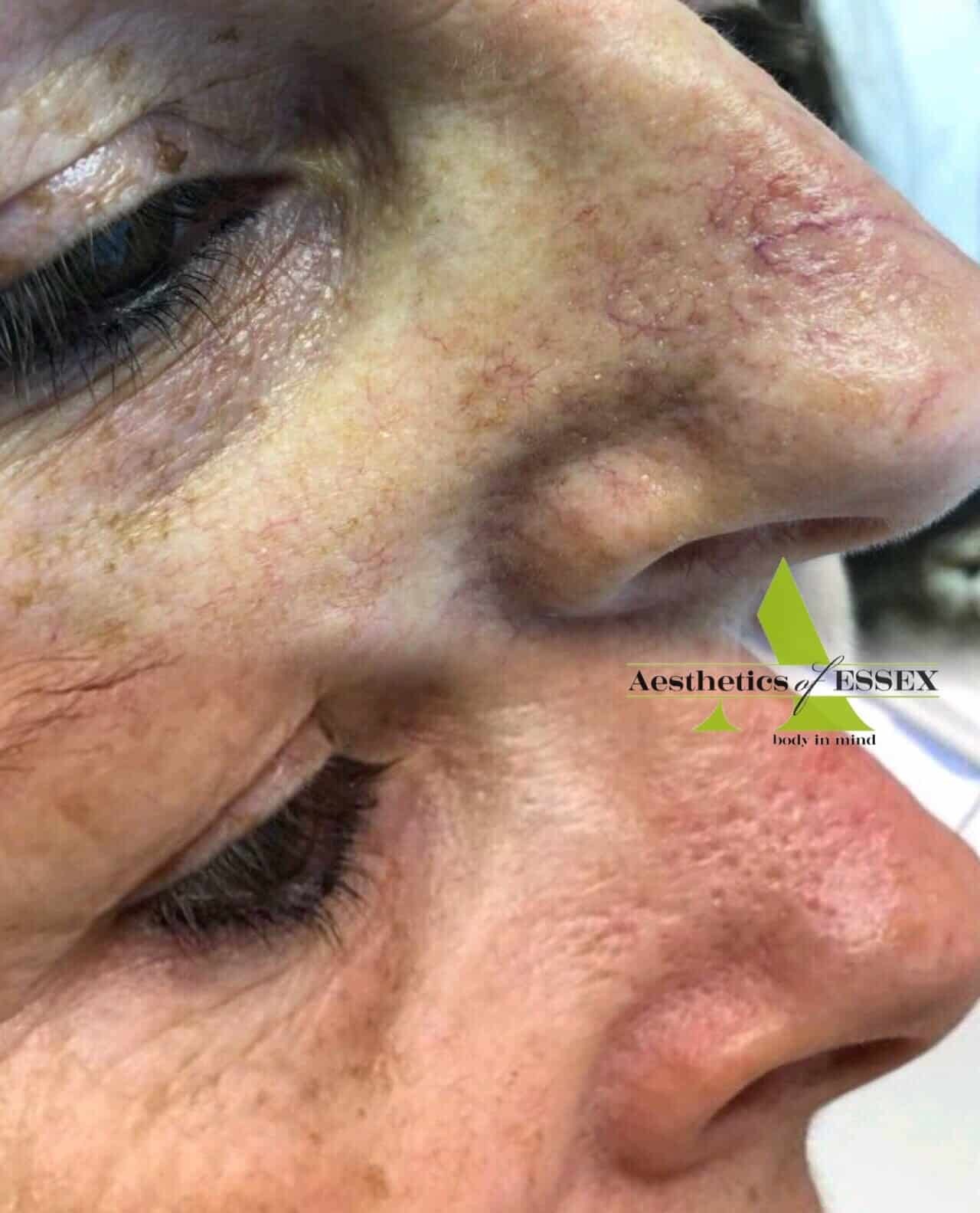 ThermaVein nose before/after