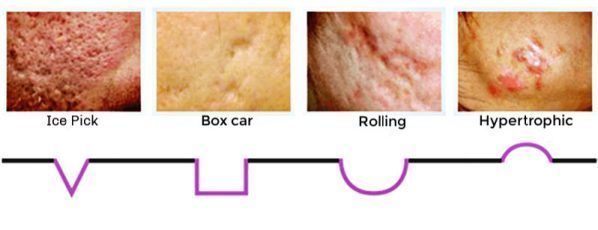 Types of scar