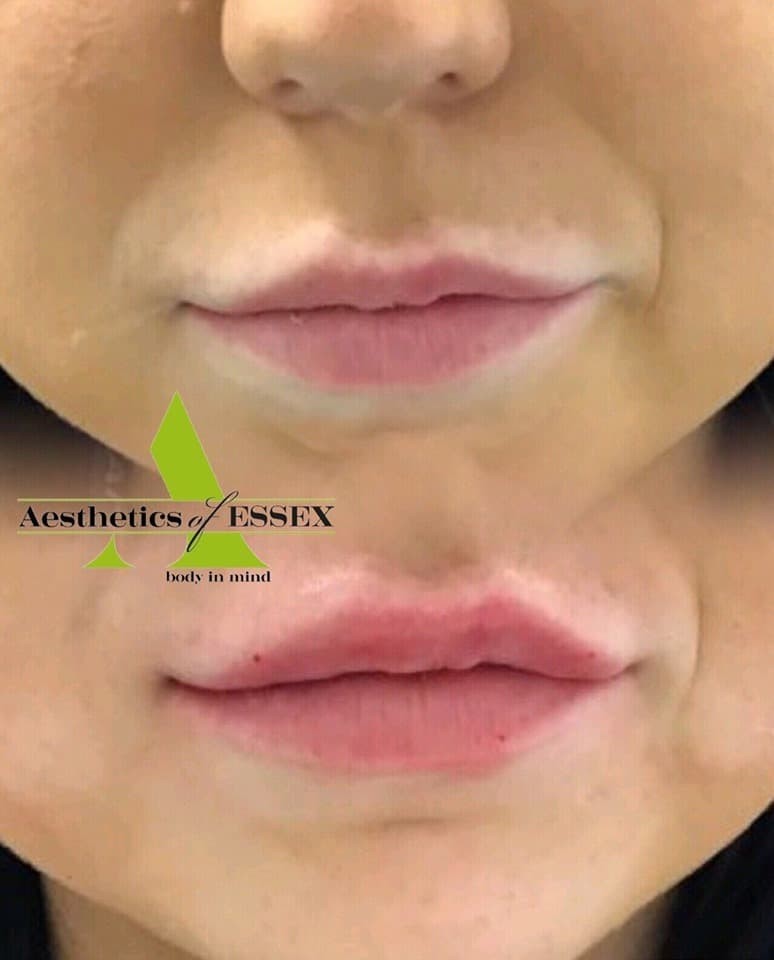 dermal fillers UK - Aesthetics of Essex