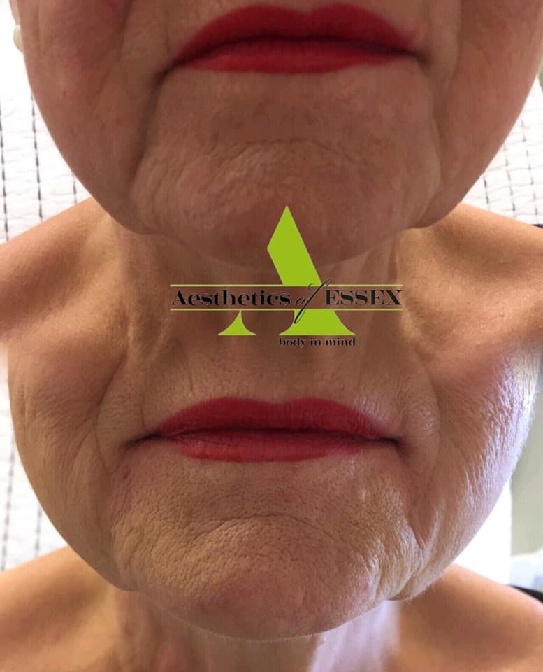 Best face filler UK - Aesthetics of Essex