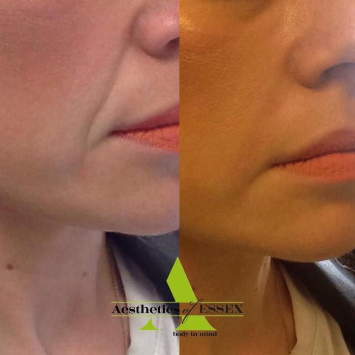 dermal fillers essex - Aesthetics of Essex