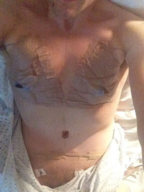 tummy-tuck-matt-stomach-after