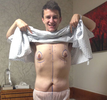 tummy-tuck-matt-stomach-before