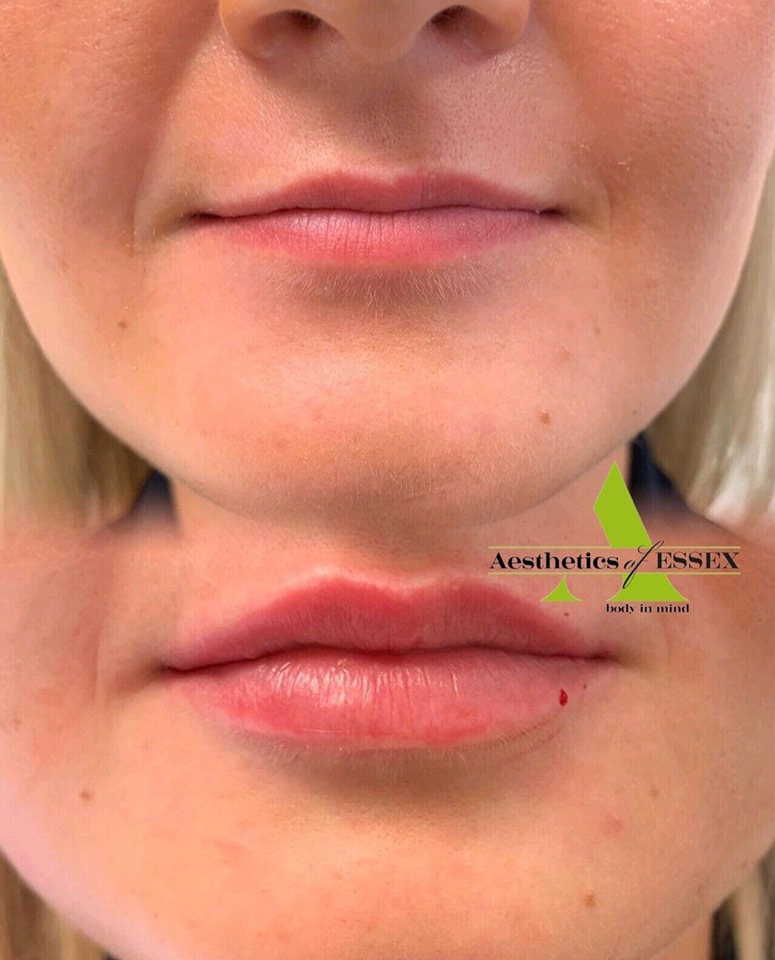 Lip Fillers In Essex Aesthetics Of Essex