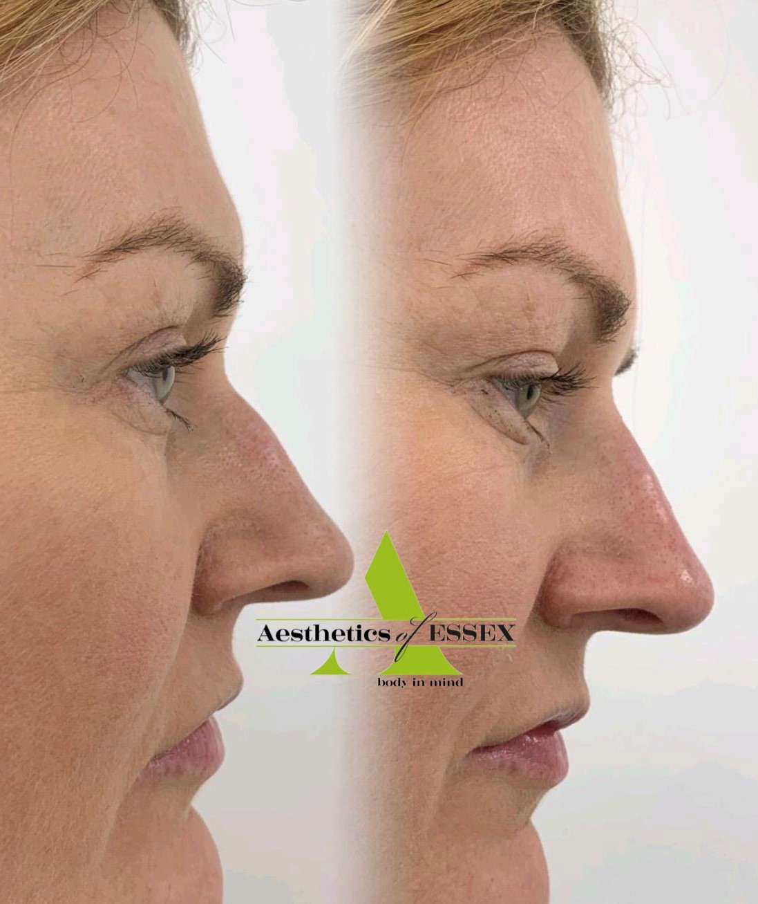 Non Surgical RhinoPlasty before/after