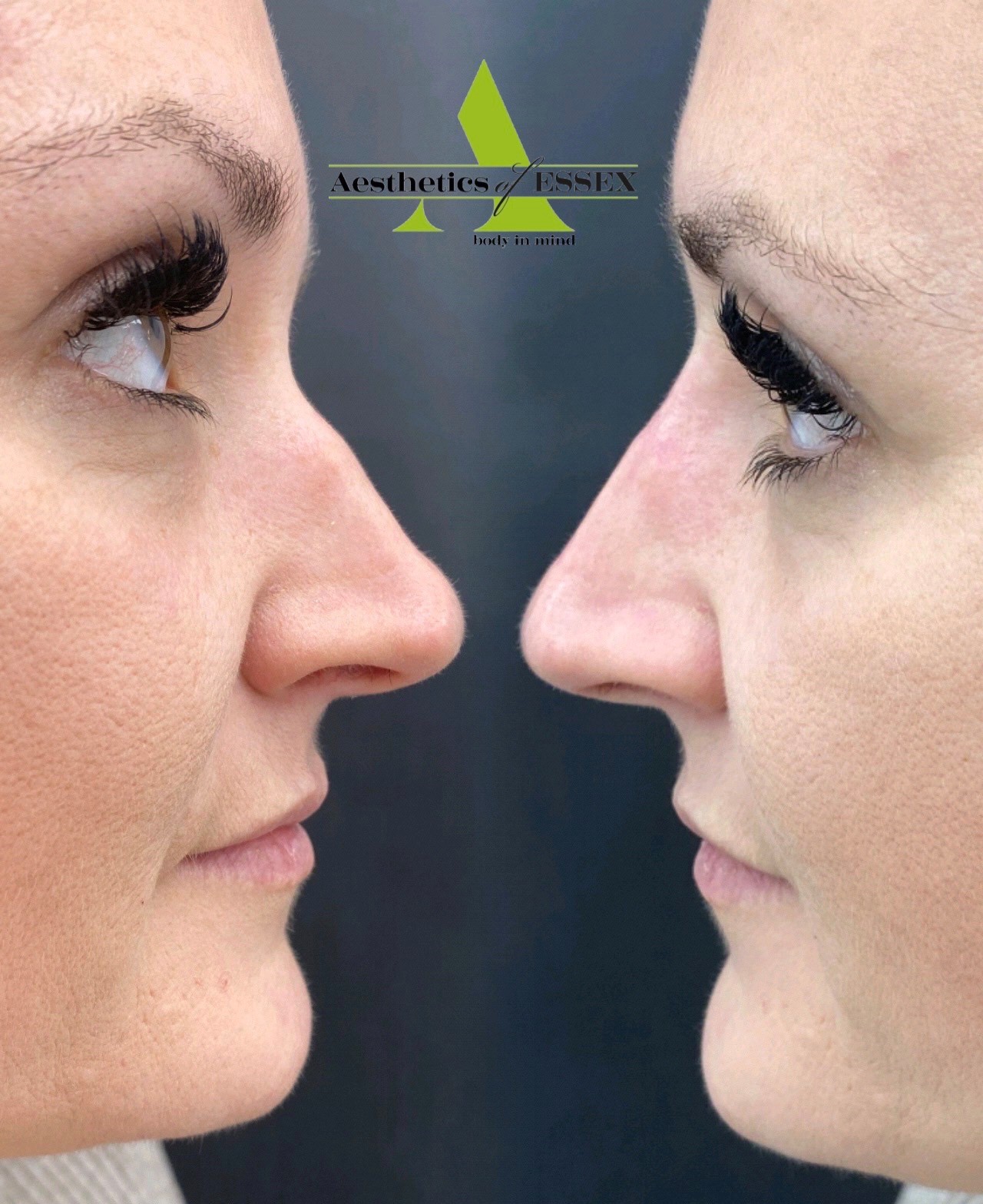 Woman who has had RhinoPlasty