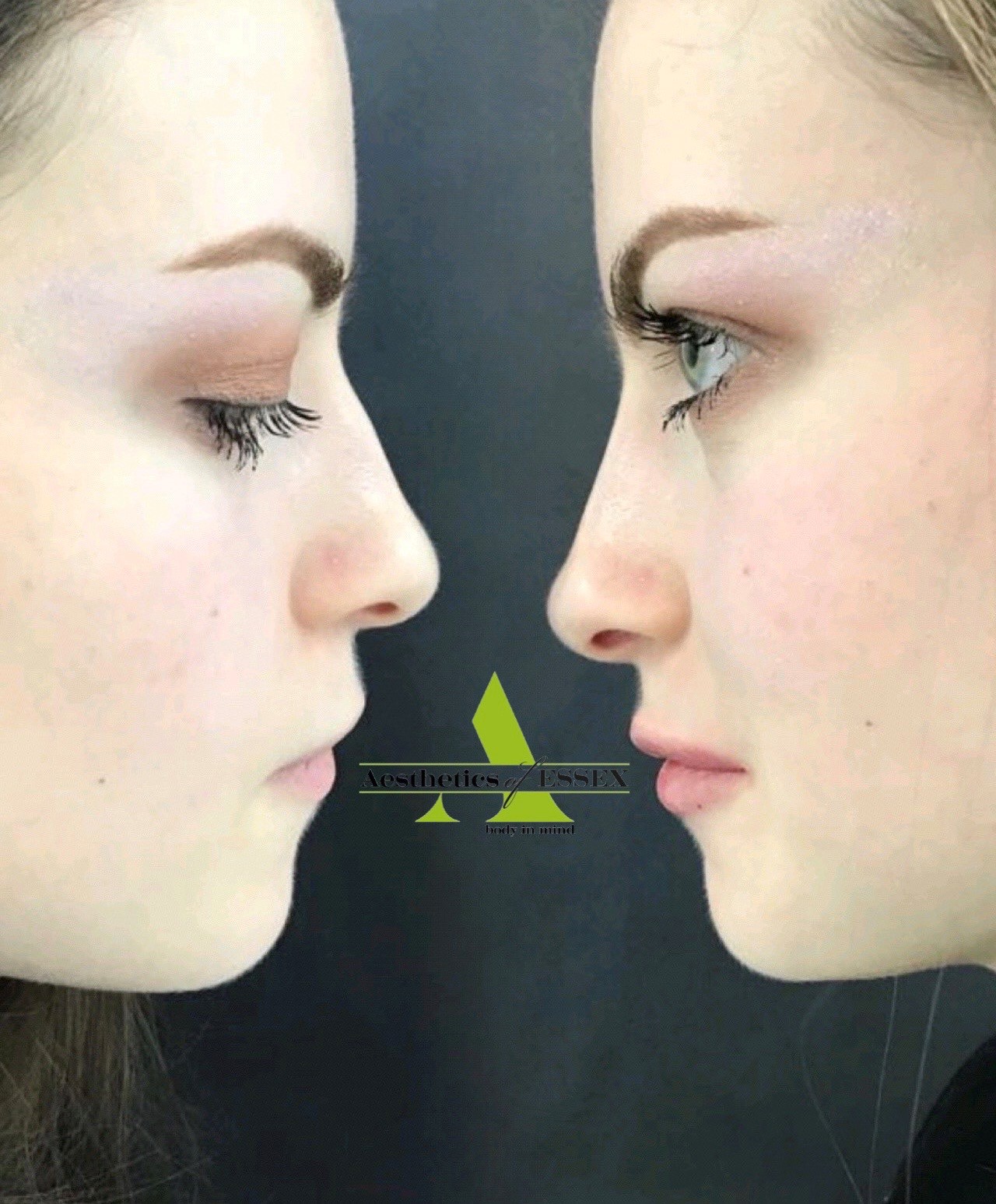 Pre/post RhinoPlasty