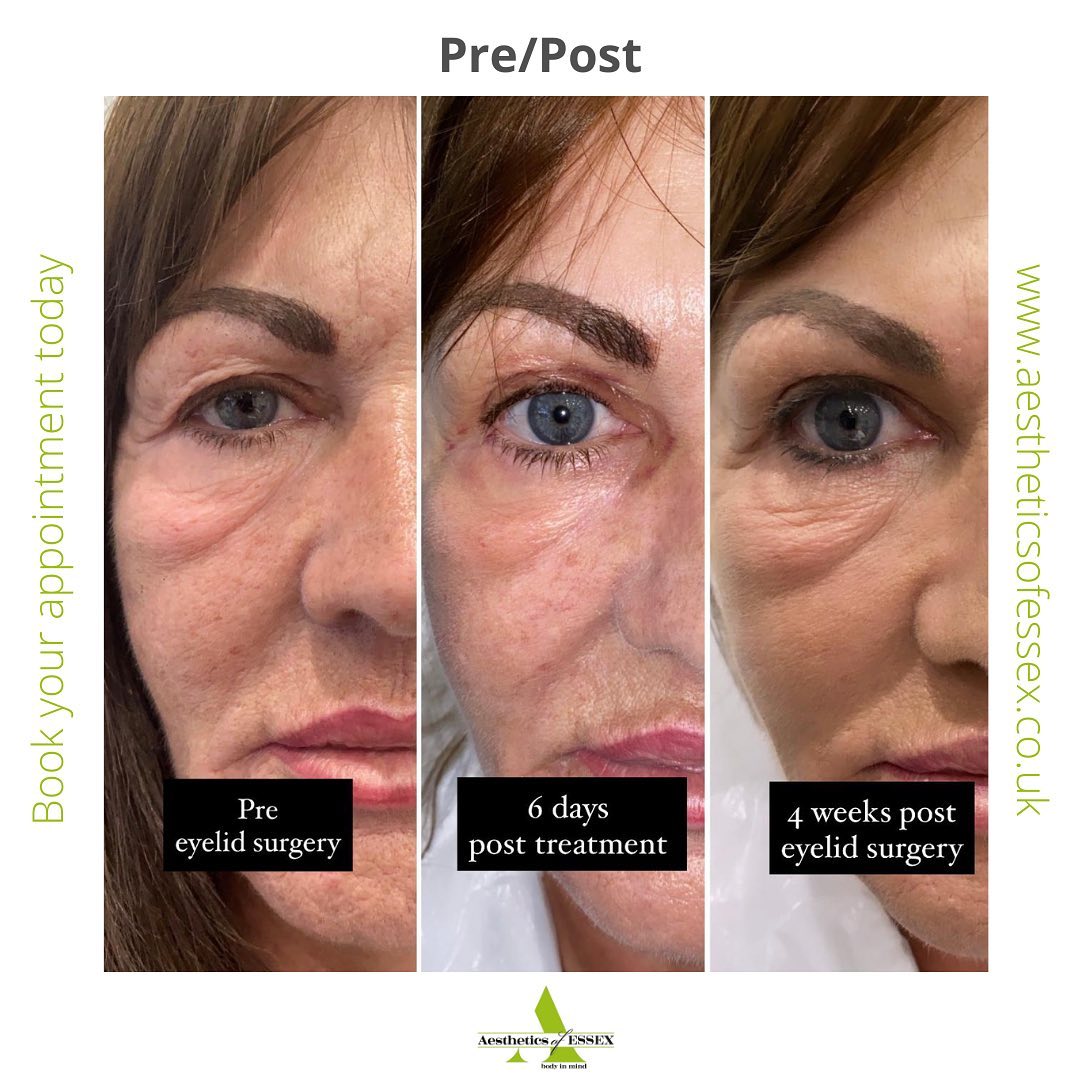 Blepharoplasty Upper Eye Lift Treatment Aesthetics of Essex