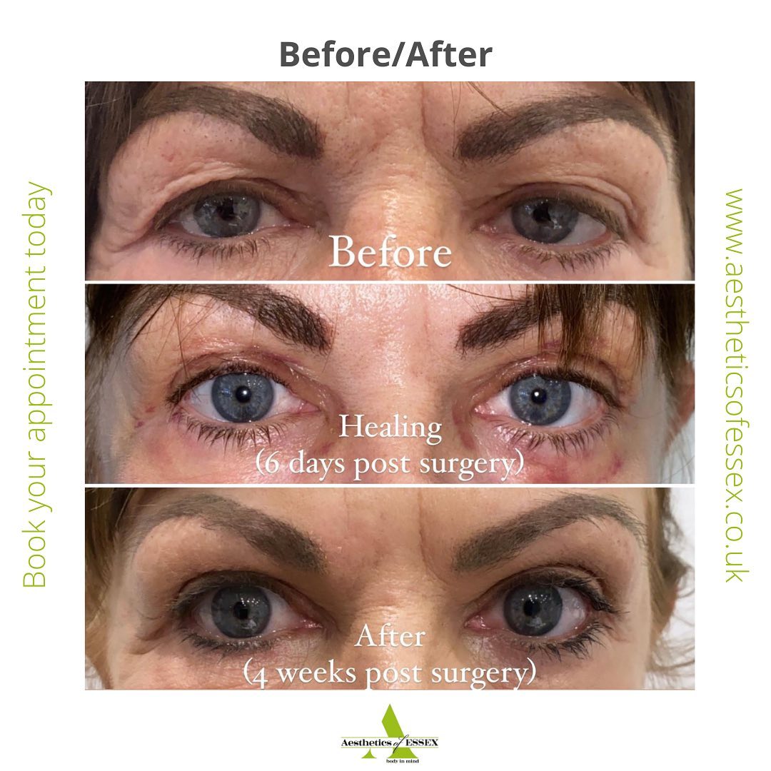 Eye Lift Blepharoplasty Essex Botox Essex Aesthetics