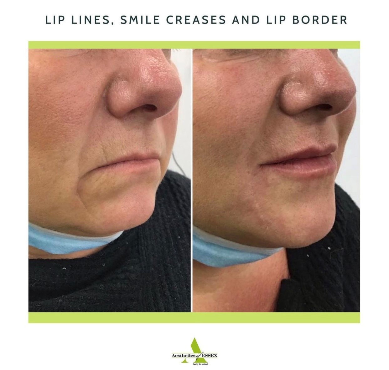 Lip line after dermal filler