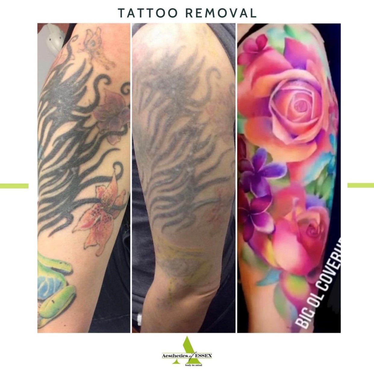 Tattoo Removal Cover Ups London