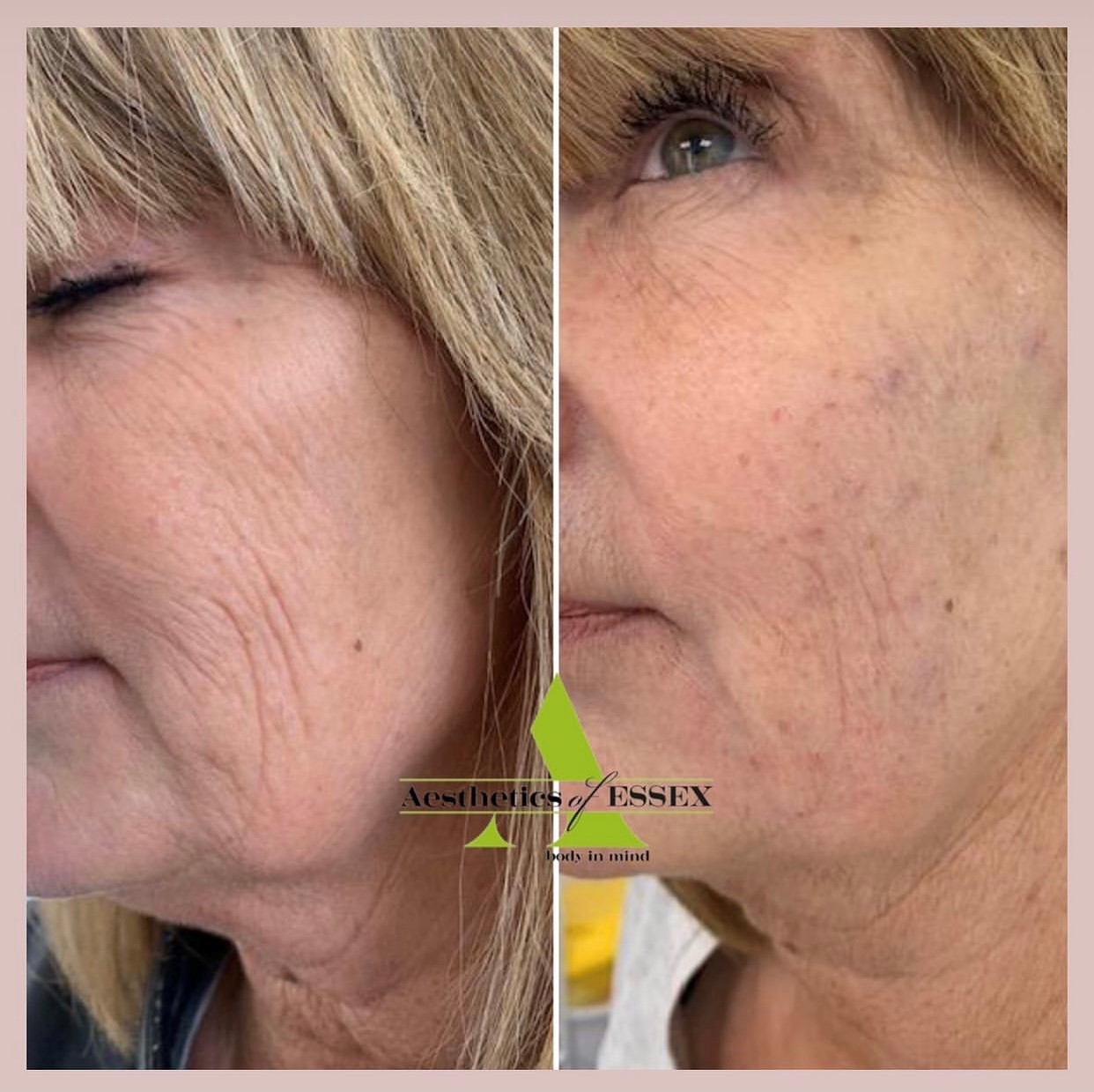 Collagen simulator before and after