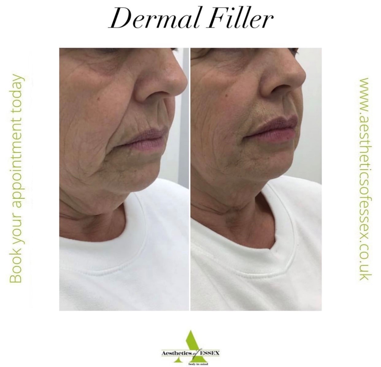 Dermal Fillers Facial Injectables Aesthetics of Essex