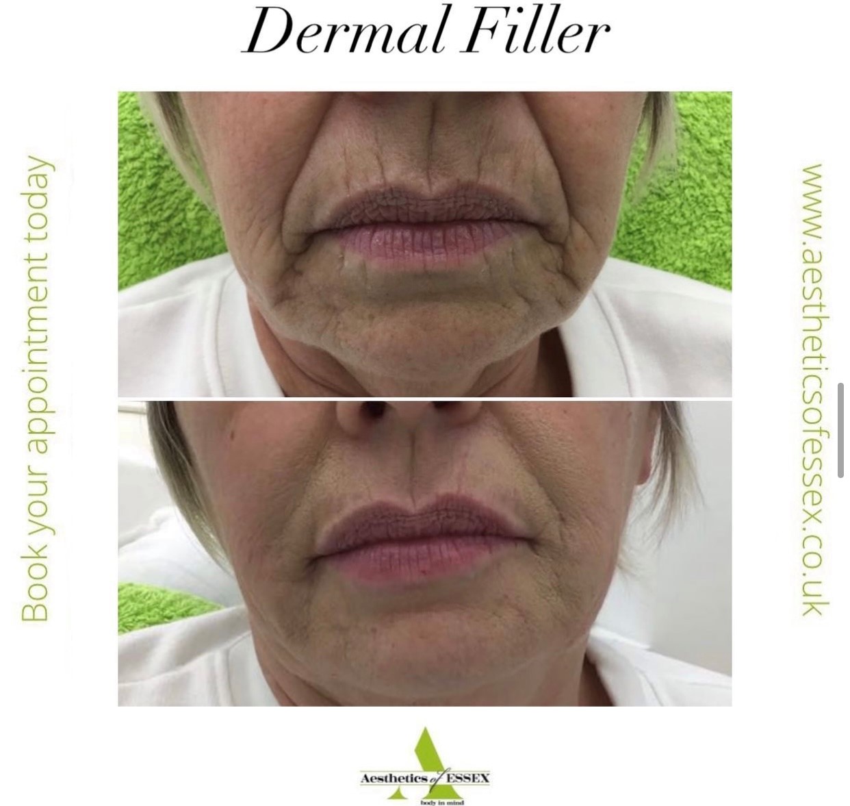 Dermal Fillers Facial Injectables Aesthetics of Essex