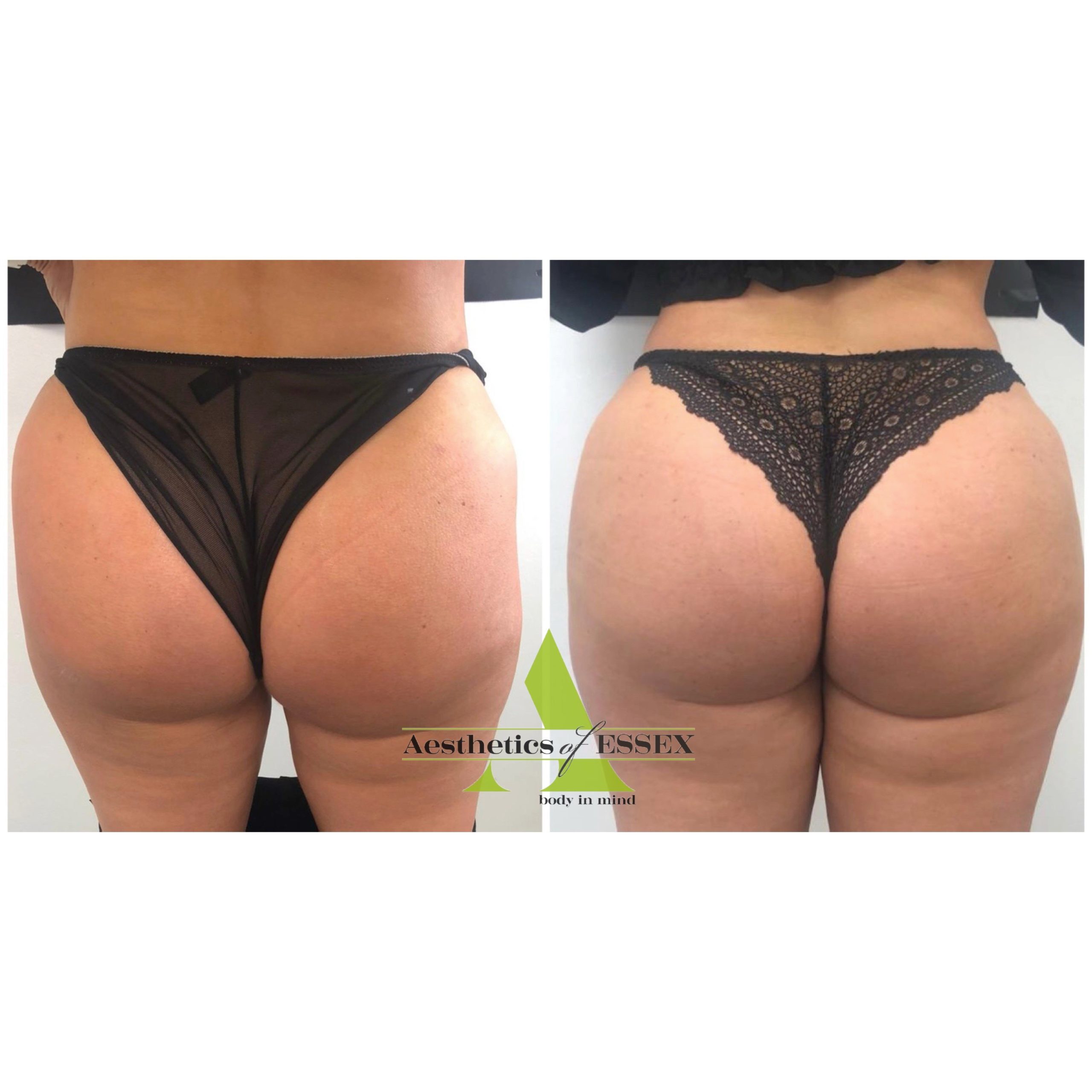 Bum Injections UK, Bum Fillers, Buttock Fillers