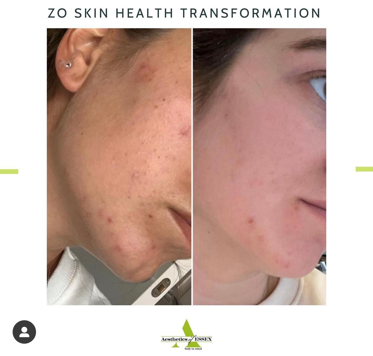 Zo skin health transformation