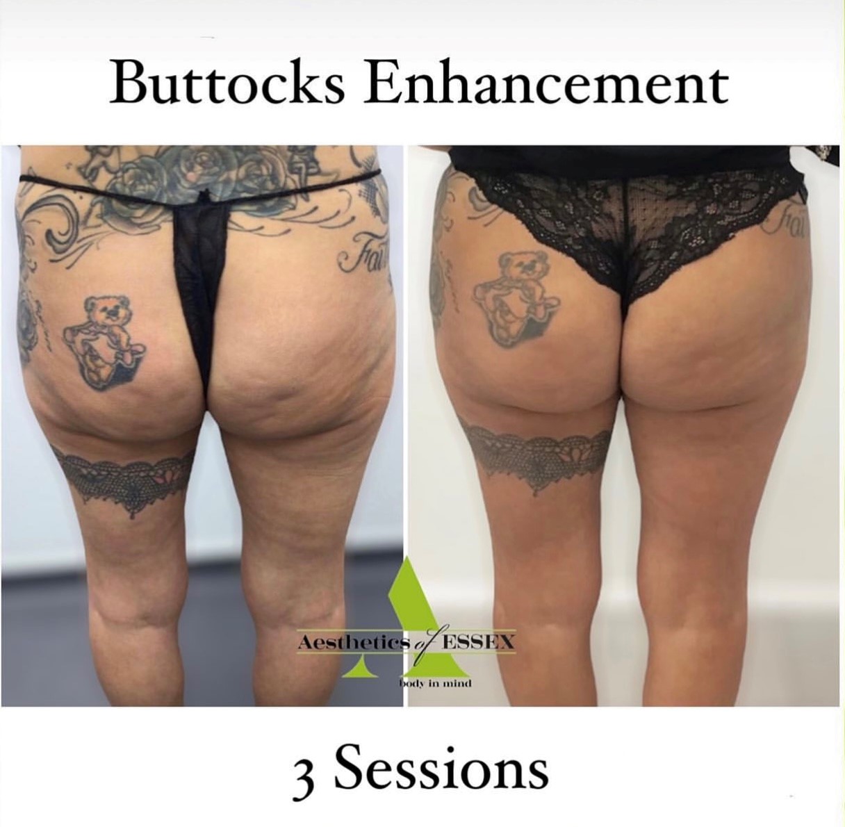 After buttocks enhancement