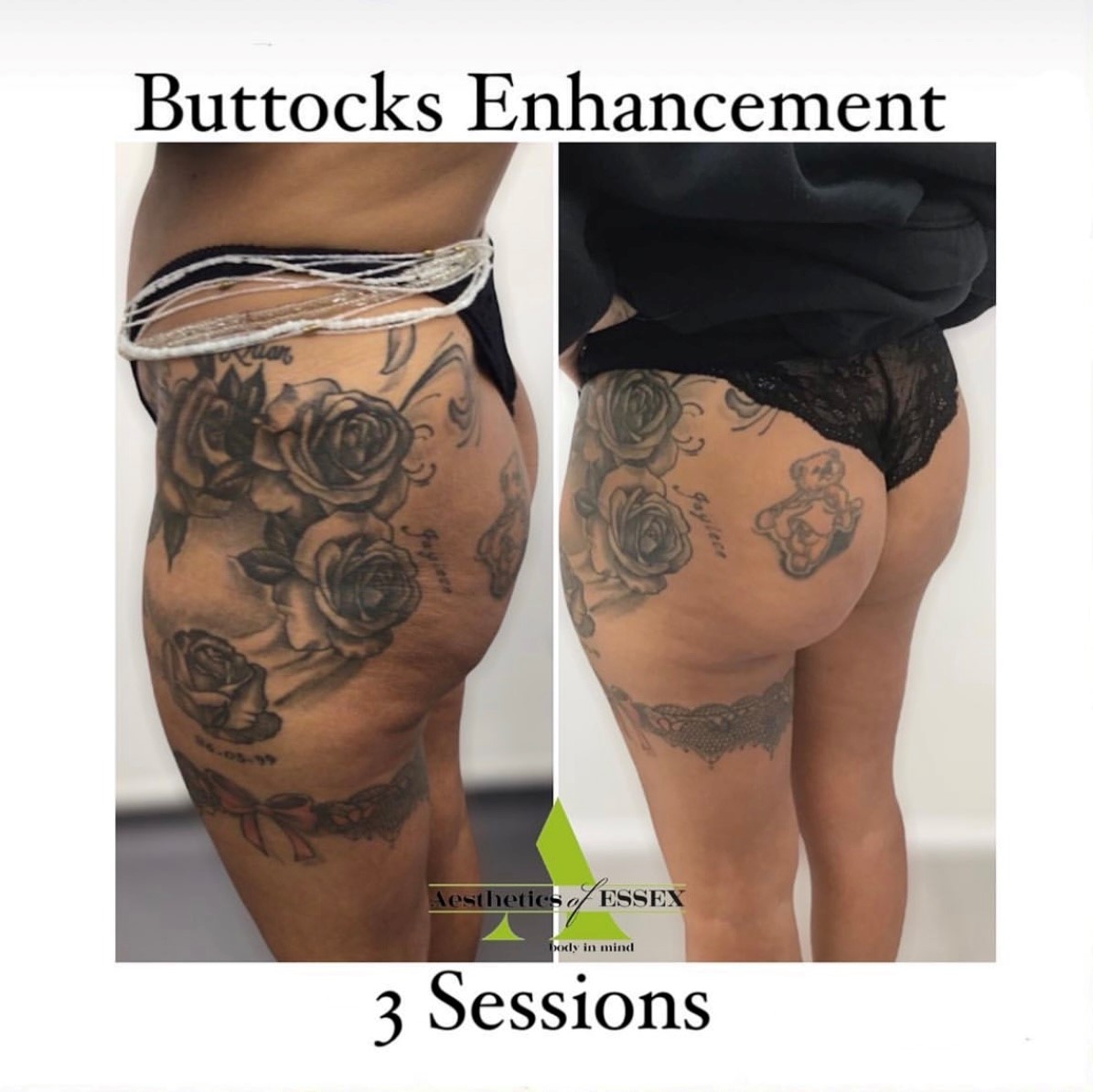 Buttocks enhancement