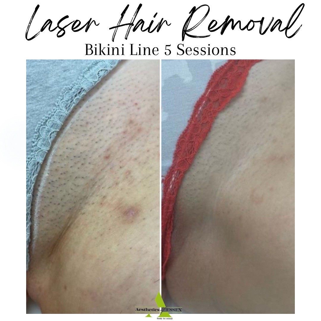 Bikini Hair Removal