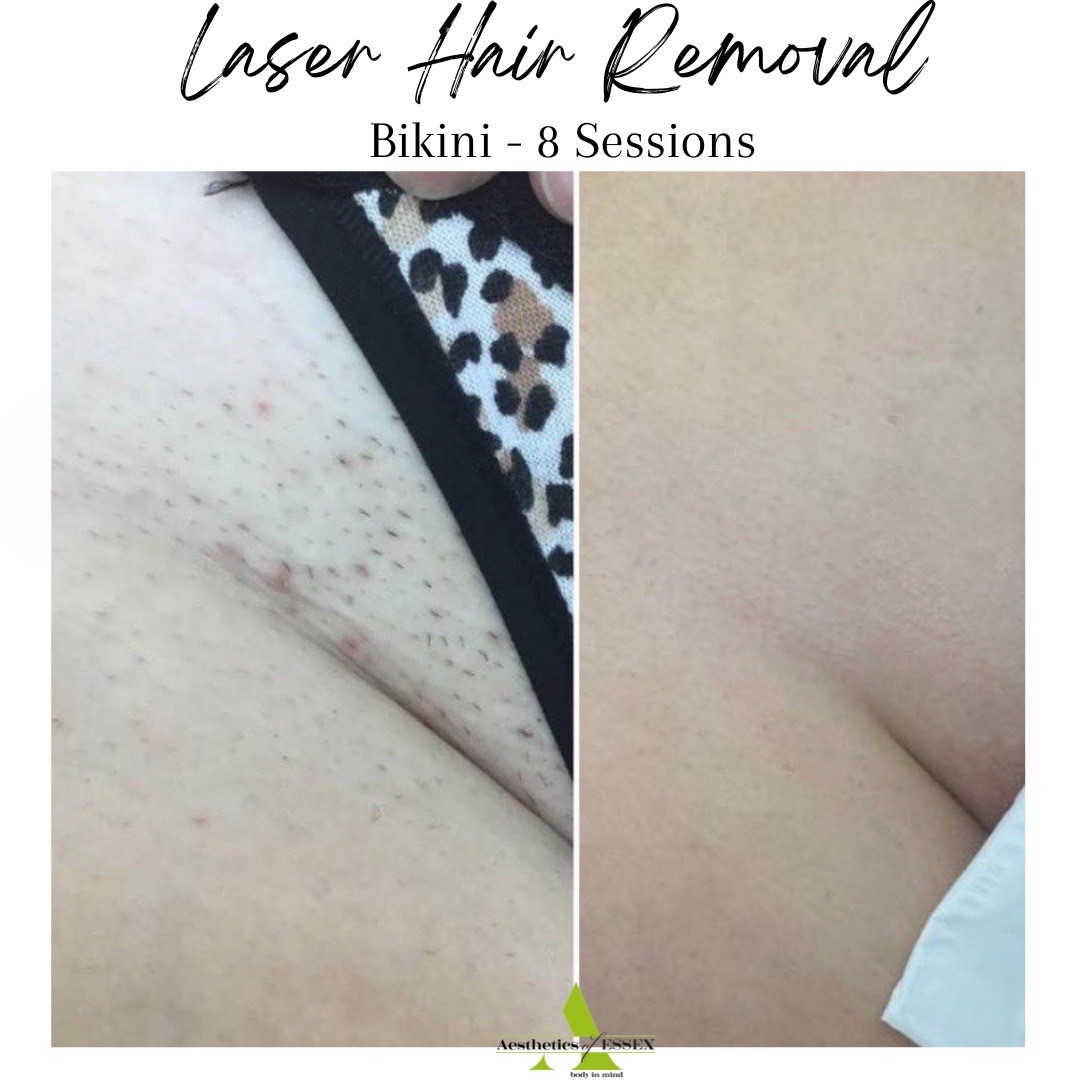 Laser hair clearance removal bikini cost