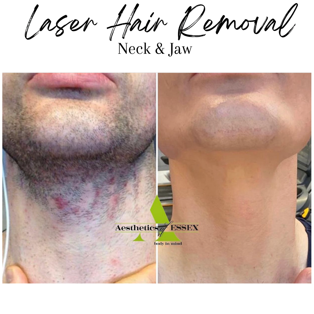 Neck and jaw laser hair removal
