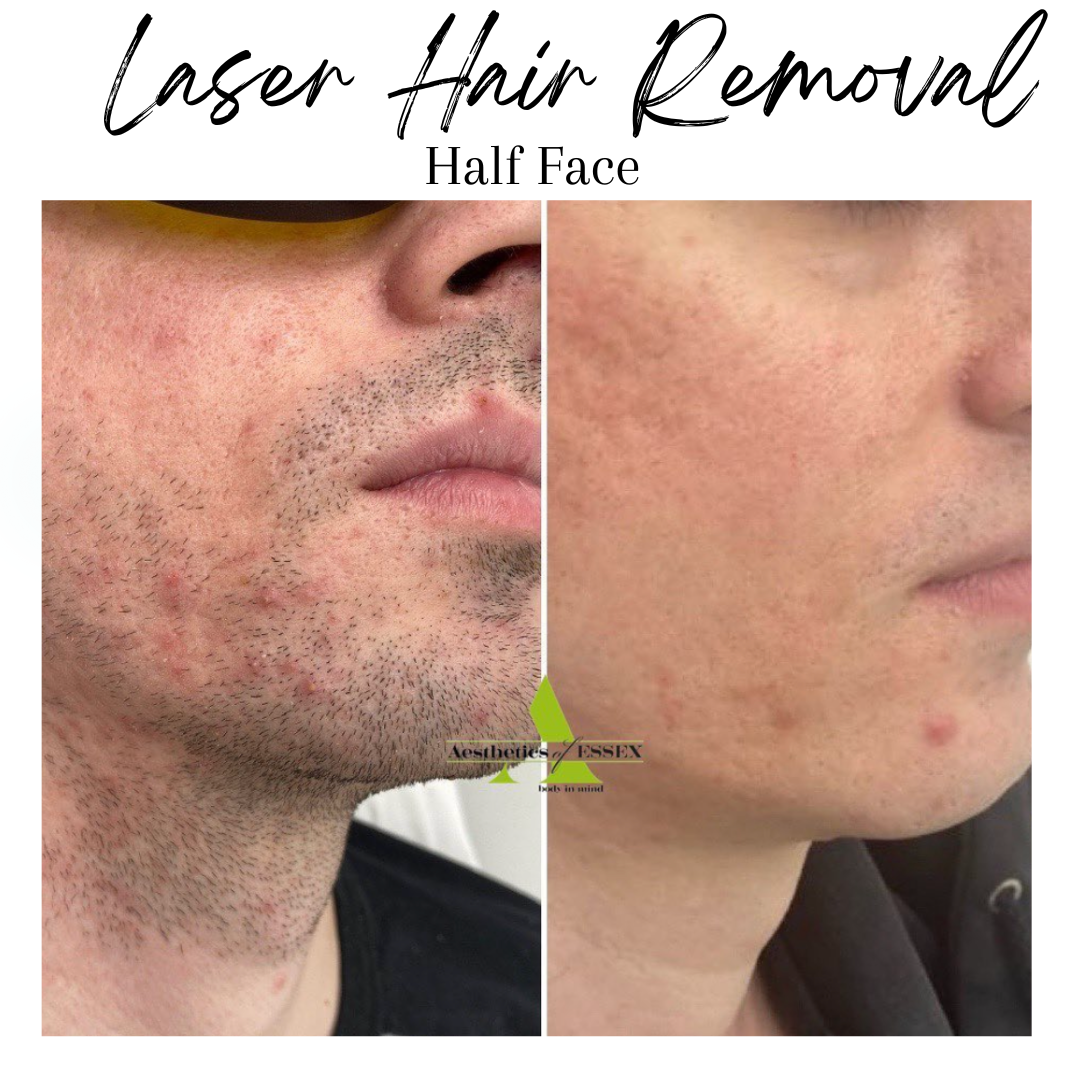 What To Know About Laser Hair Removal On Face Hotsell www