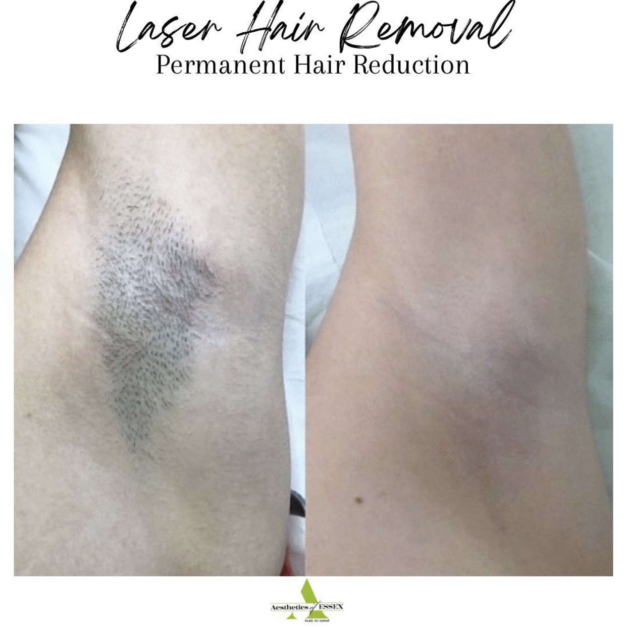 Laser Hair Removal - Aesthetics of Essex