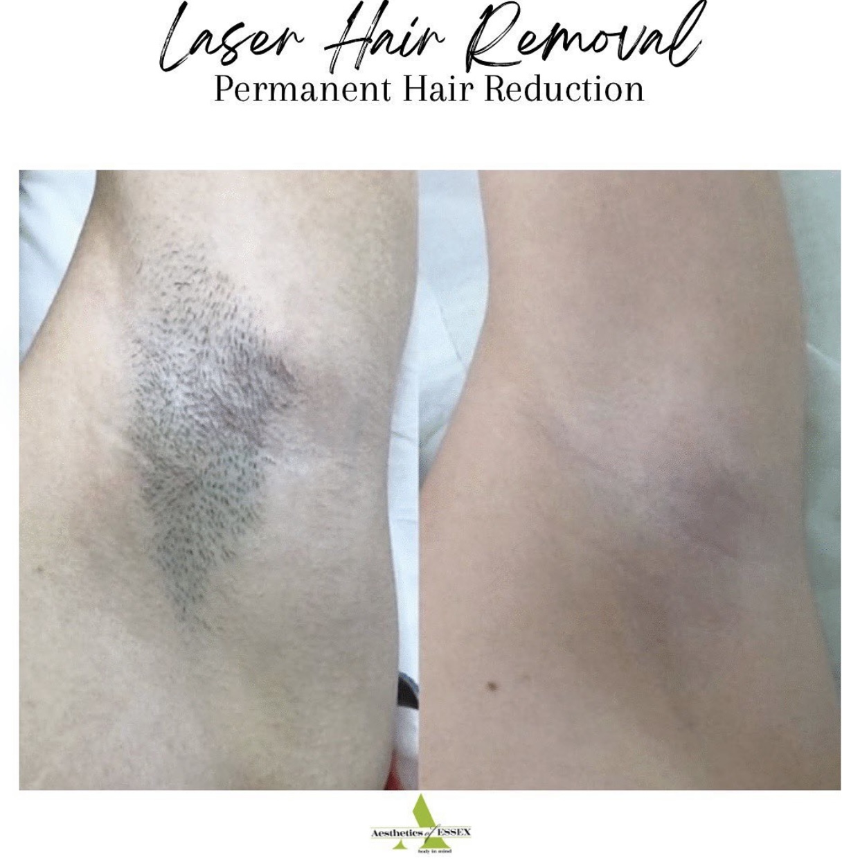 Laser Hair Removal Essex - Aesthetics of Essex