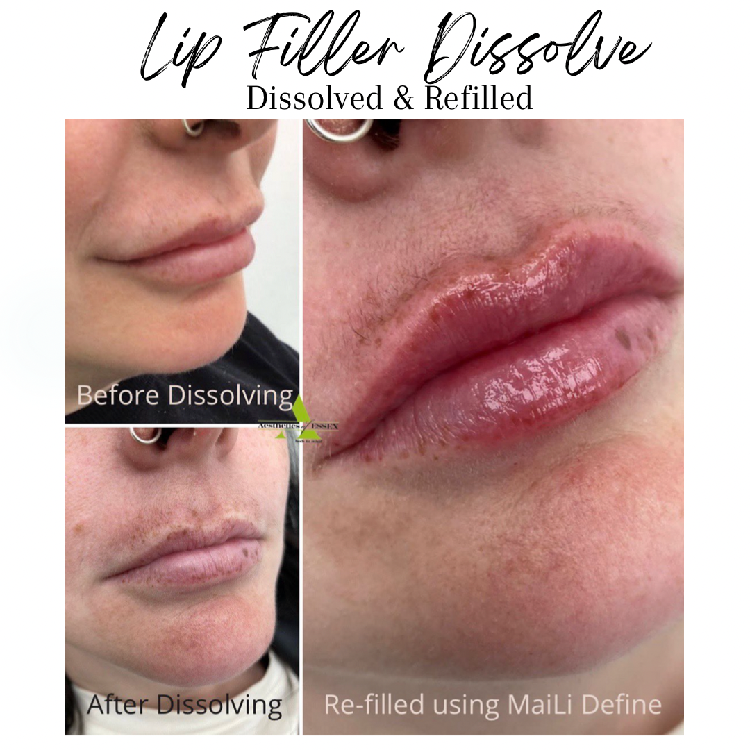 Lip filler dissolve before and after
