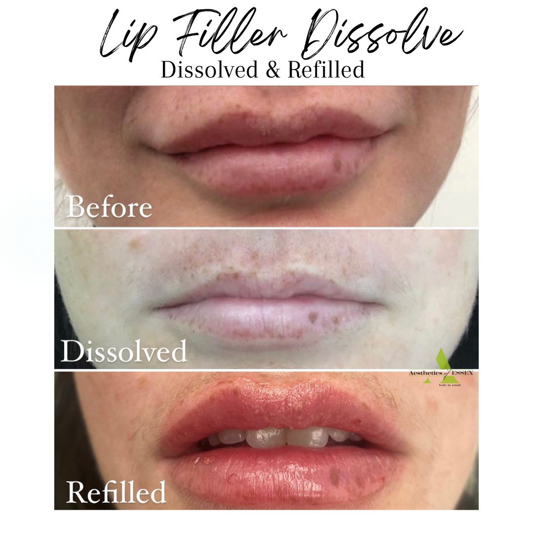Dissolved and refilled lip filler