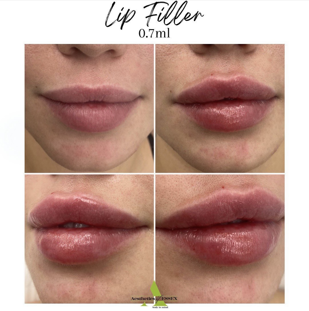 Before and after treatment lip filler