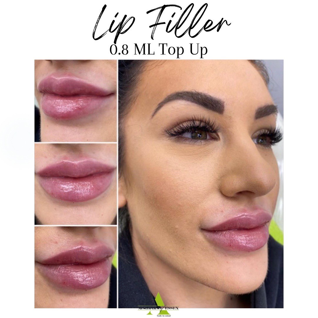 Top up lip filler