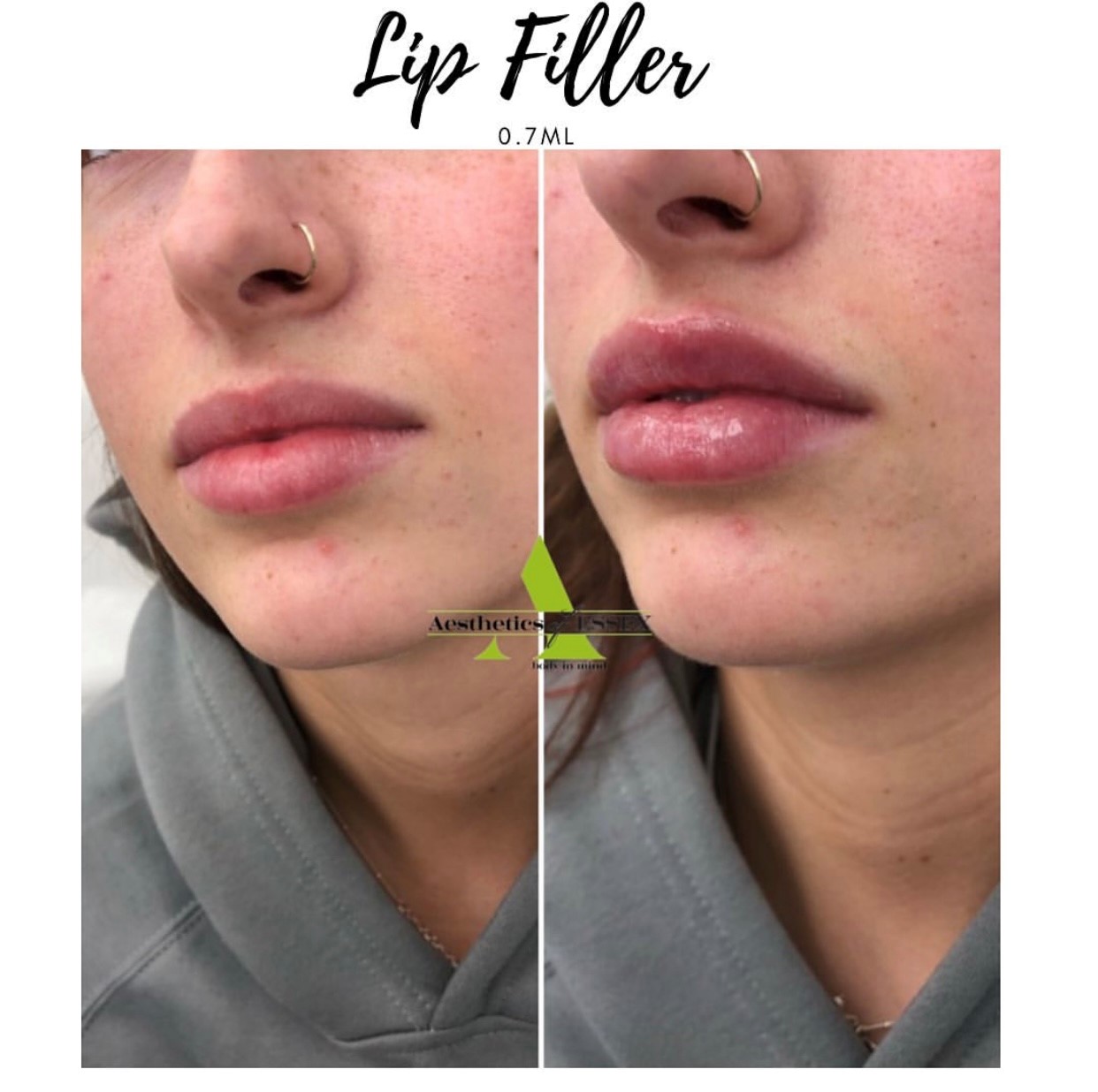 Before and after Lip filler