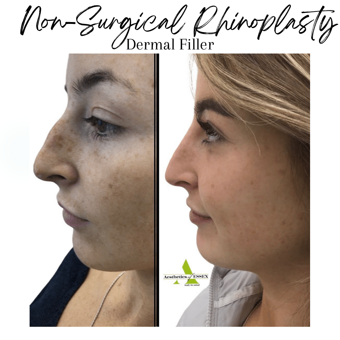 Non-surgical Rhinoplasty before and after