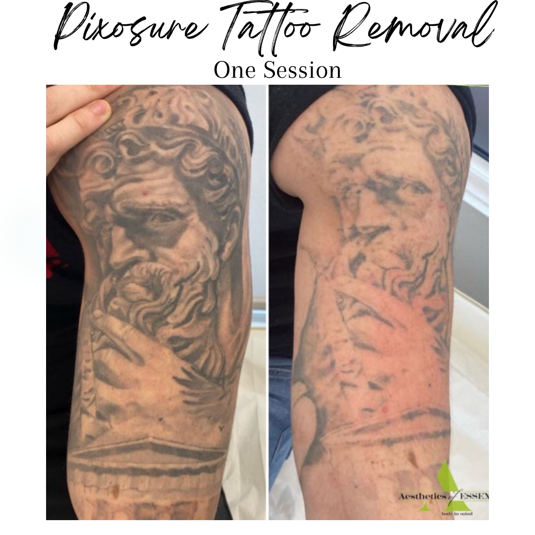 Tattoo removal after one session
