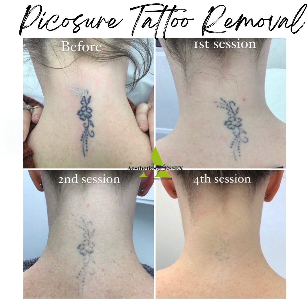 Tattoo removal after 4th session