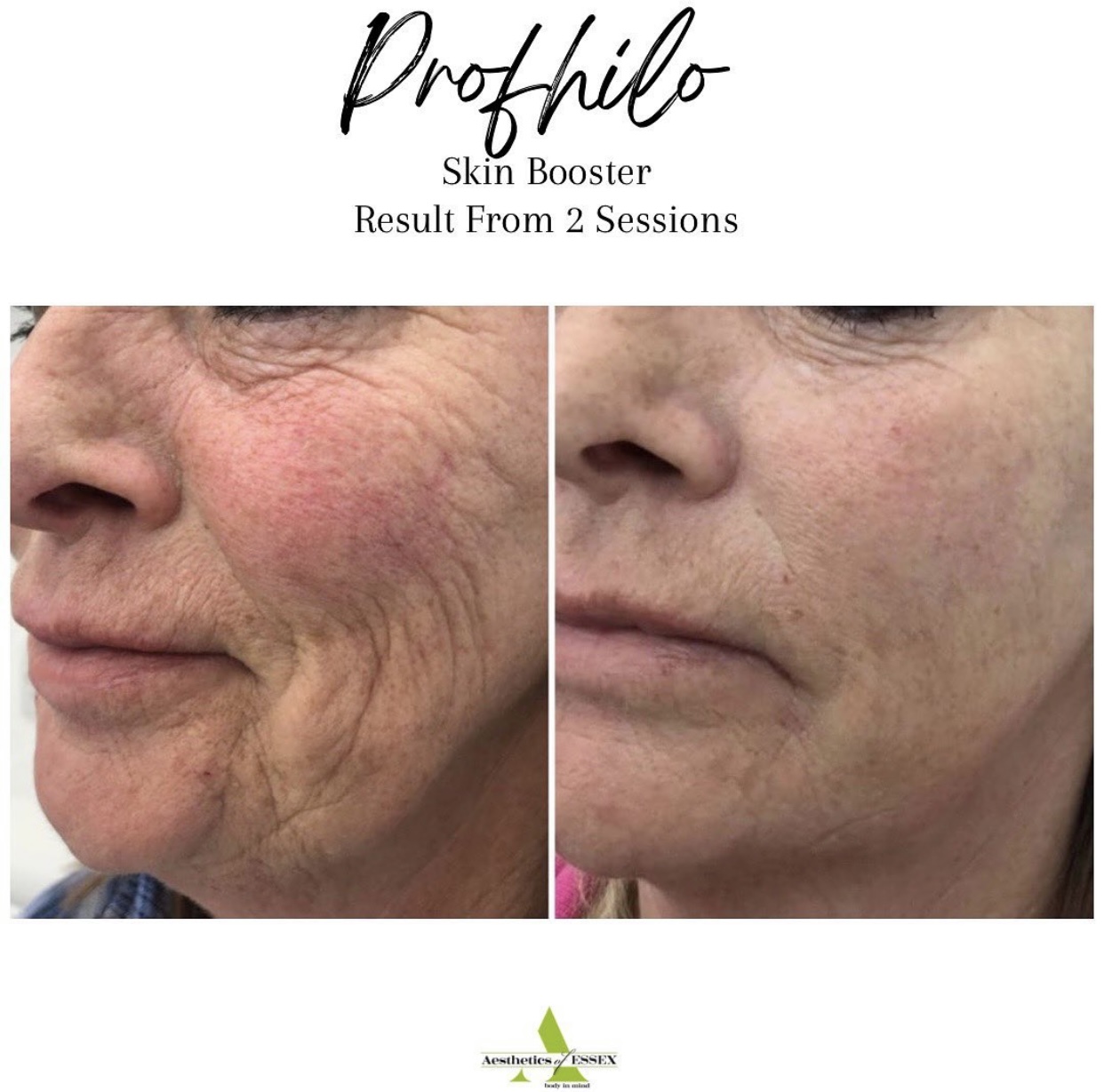 Profhilo before and after treatment