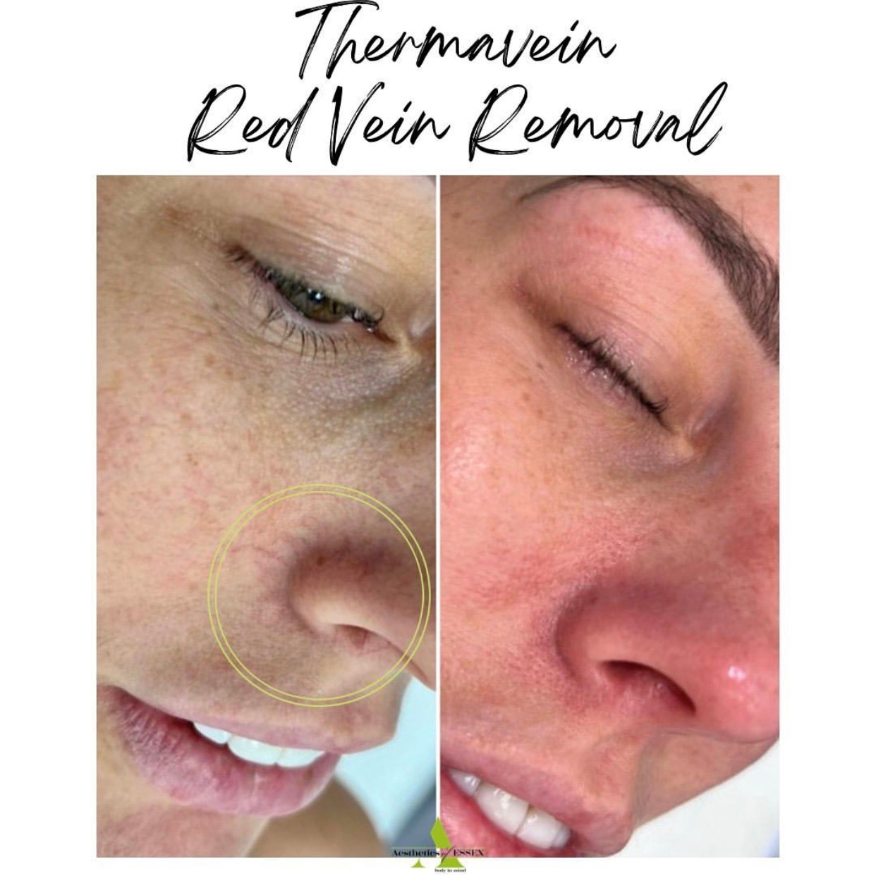 Thermavein red vain removal