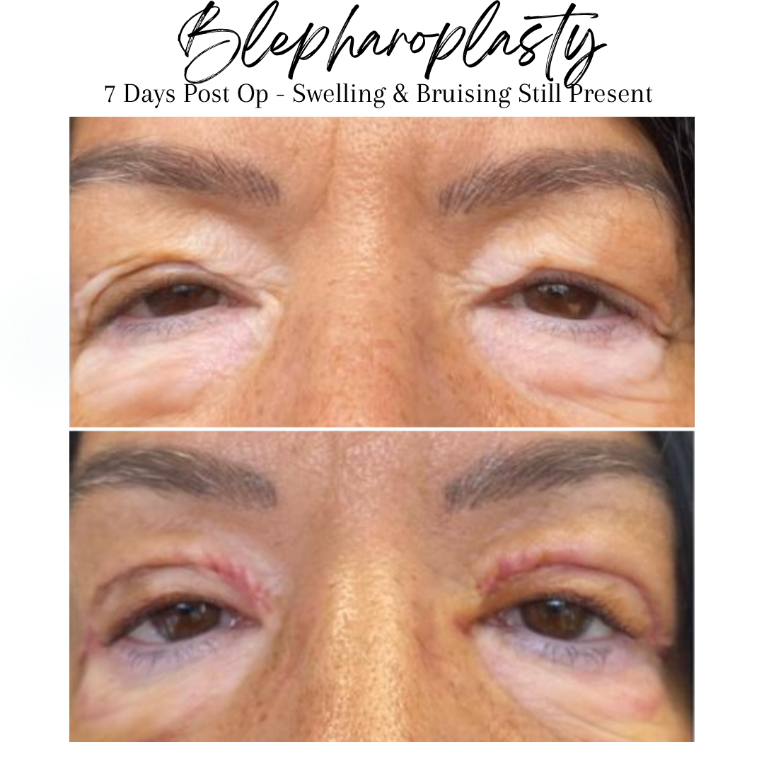 Blepharoplasty Essex - Eye lift