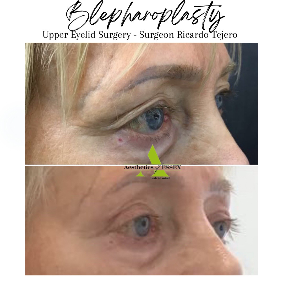 Blepharoplasty