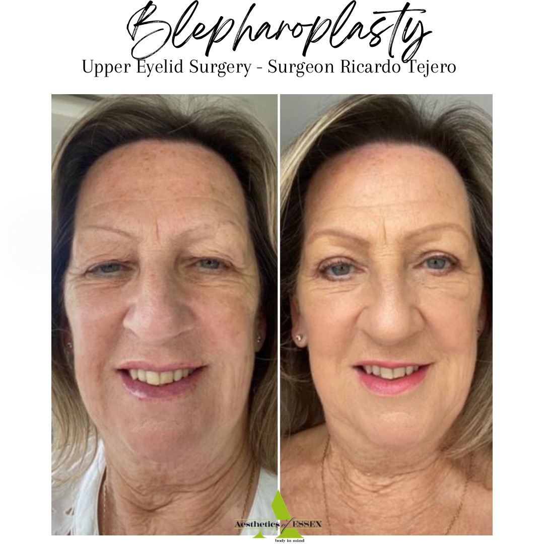 Blepharoplasty uk deals